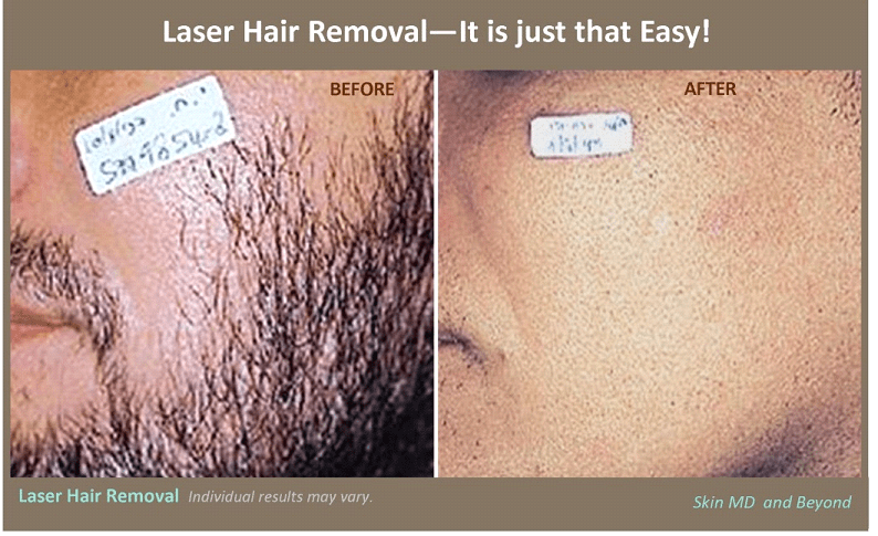 Laser Hair Removal 6