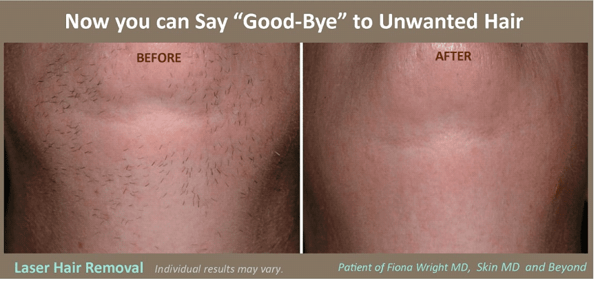 Laser Hair Removal 7