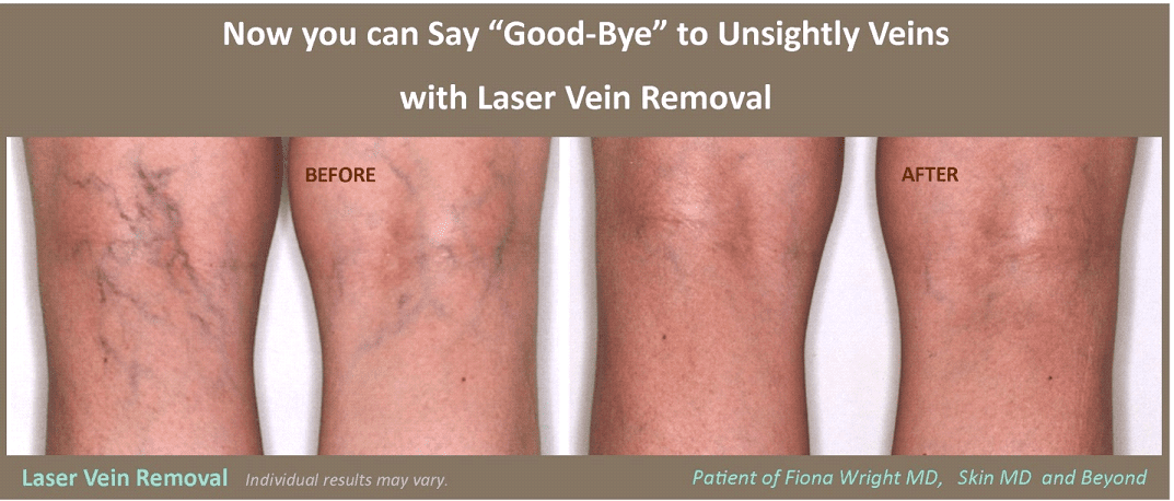 Laser Hair Removal 8