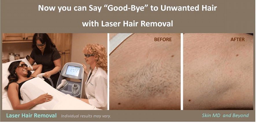 Laser Hair Removal