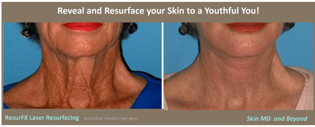 Laser Resurfacing ResurFX 2