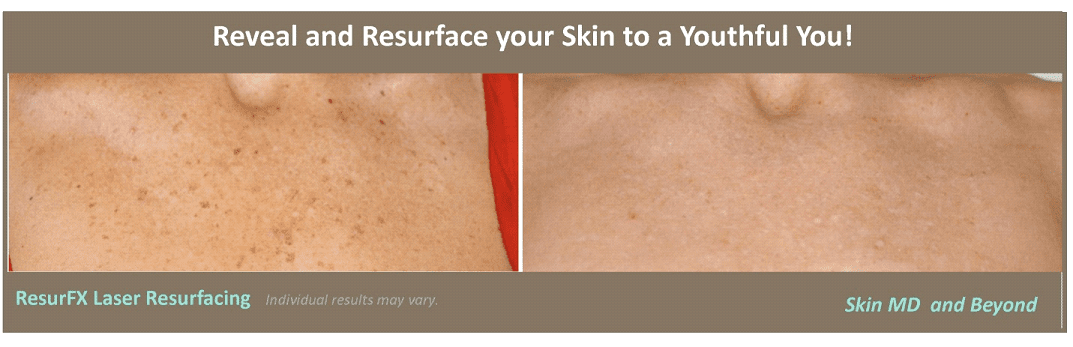 Laser Resurfacing ResurFX