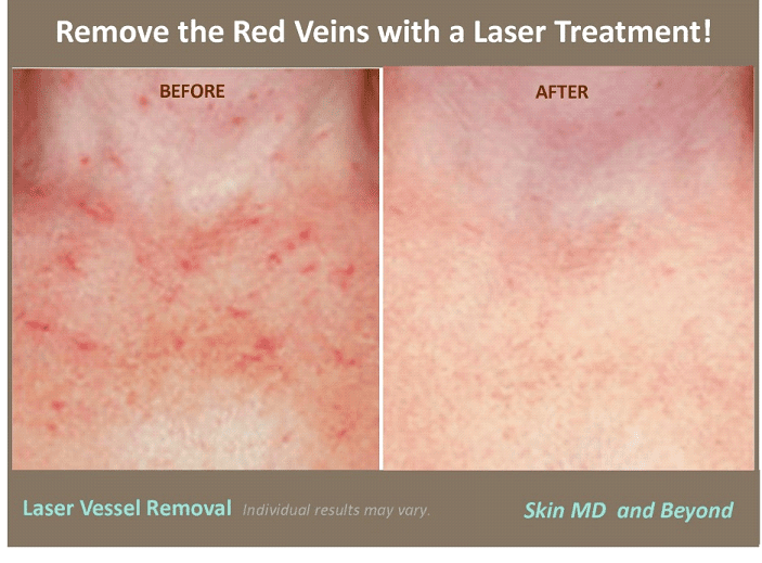 Laser Vein Removal