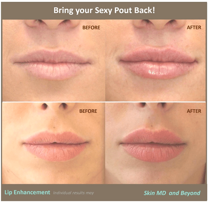 Lip Enhancement