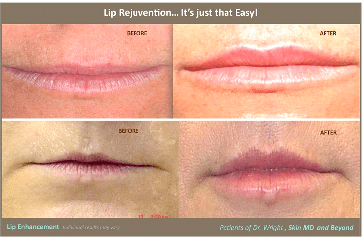 Thin Lips Treatment Plano Tx Flat Lips Treatment Frisco Tx