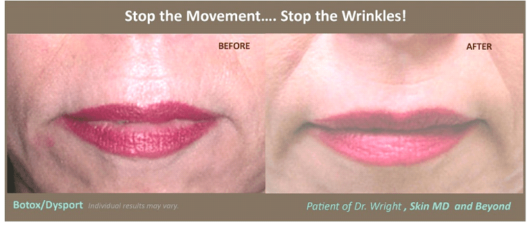 vertical red line above upper lip