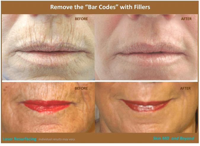 Lip Lines Borders Facial Fillers Laser Resurfacing Plano TX