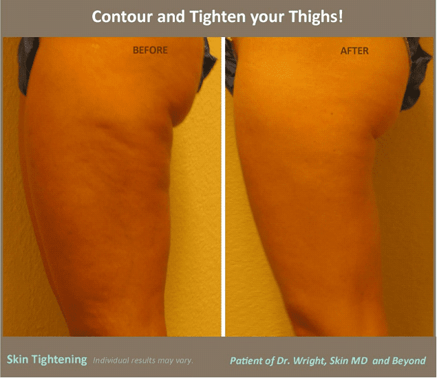 Treat Saggy Arms with Non-Surgical Skin Tightening