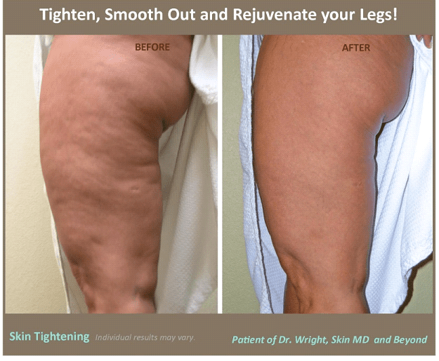 Loose Skin Treatment Plano TX  Skin Laxity Treatment Frisco TX