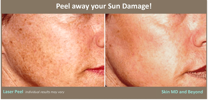 Micro Laser Peel