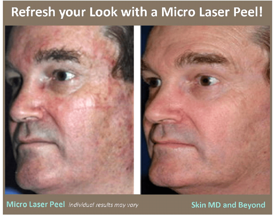 Micro Laser Peel in Plano, TX | Skin MD &amp; Beyond