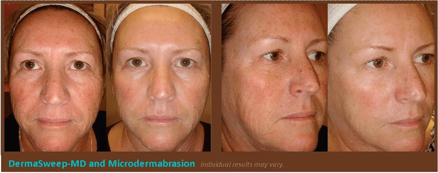 Microdermabrasion Before and After Plano, TX