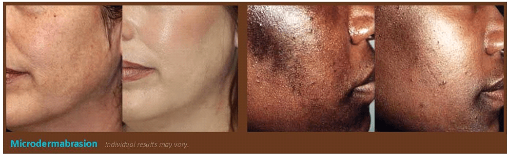 Microdermabrasion Treatment Results Plano, TX