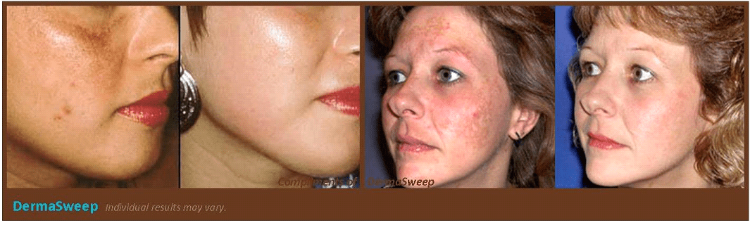 DermaSweep Treatment Results Plano, TX