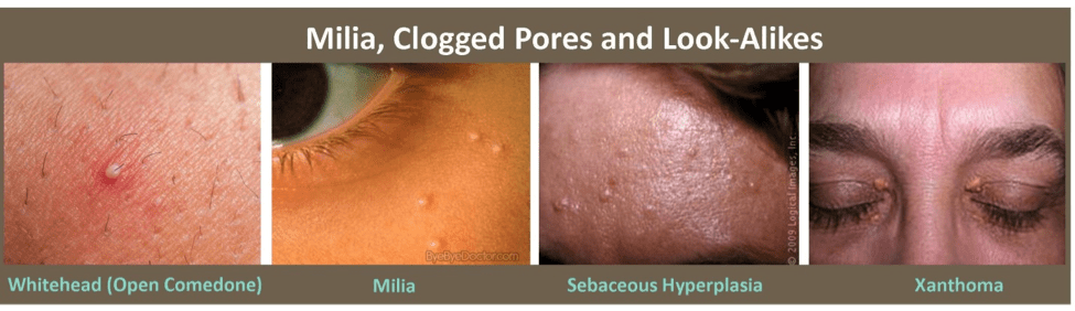 clogged pores bumps