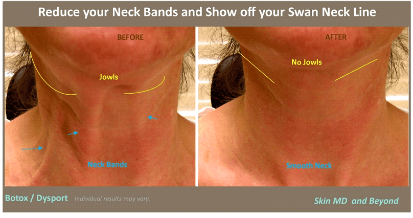 how reduce face fat BANDS Skin Care Cosmetic â€“ Neck CORDS/ Rejuvenation   NECK