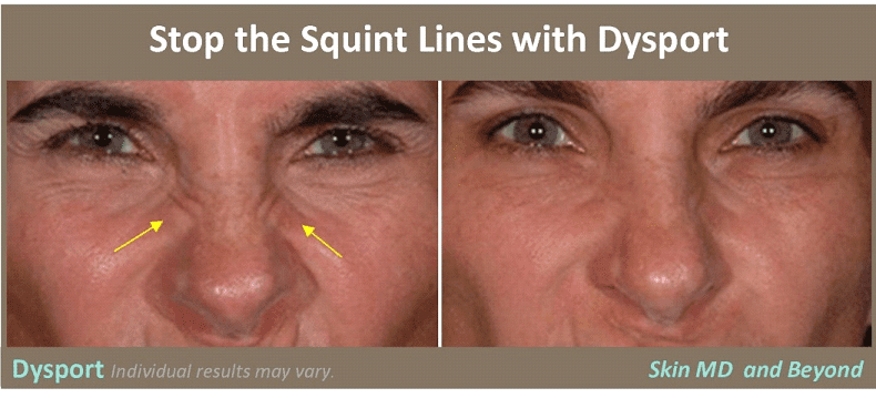 Nasal SQUINT LINES