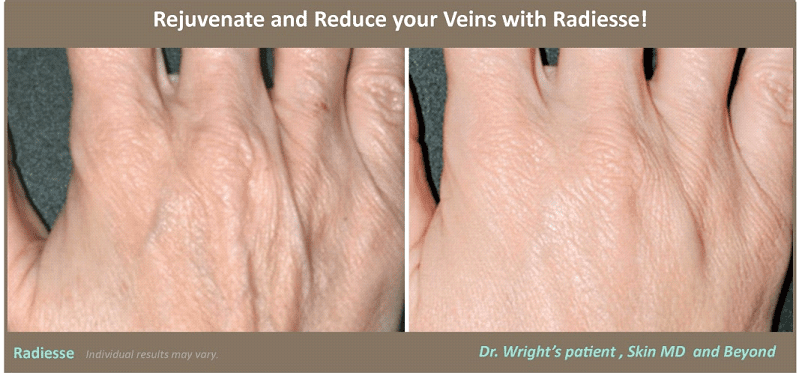 PROMINENT VEINS