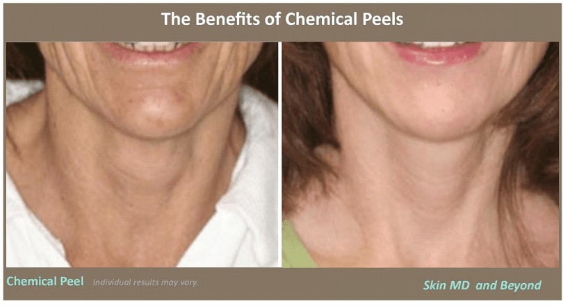 Photofacial – IPL