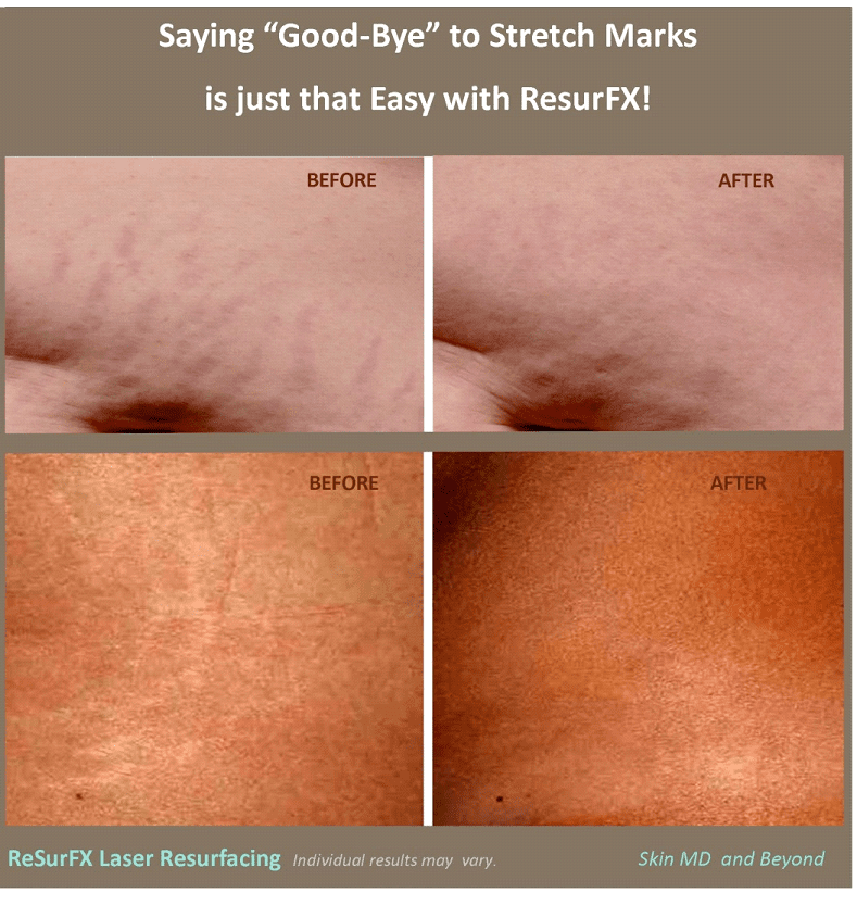 Stretch Marks Treatments Plano, TX Scar Treatment Skin MD & Beyond