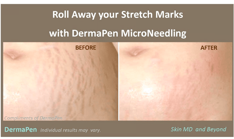 Hate Stretch Marks? Try Microneedling: Jordan Valley Dermatology Center:  Dermatologists