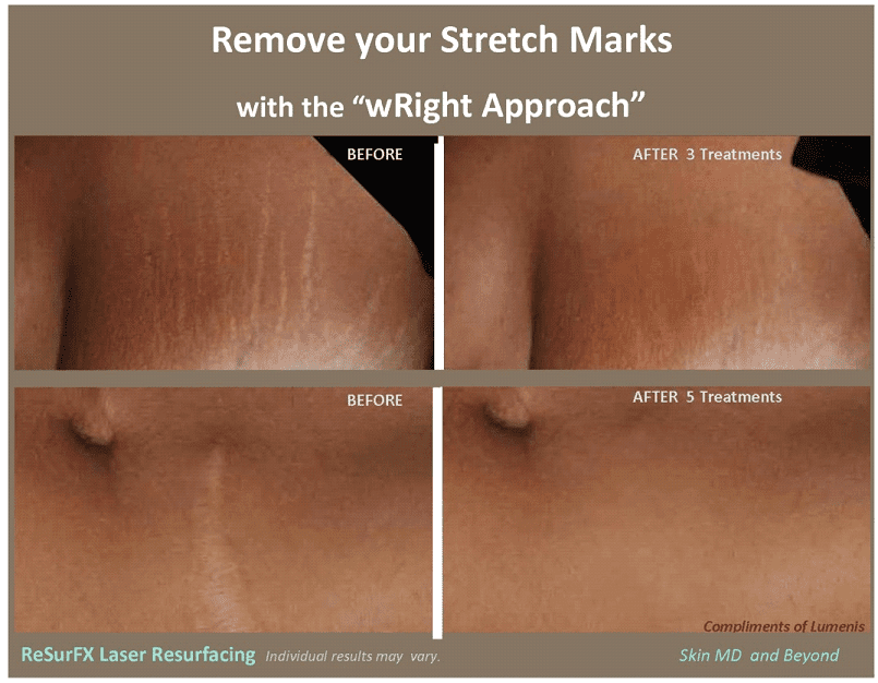 White stretch marks: Treatments, causes, and more