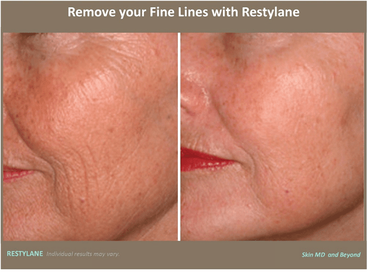 Restylane