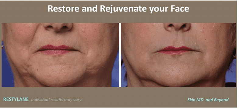 Restylane® Silk for Wrinkles and Lines around the Mouth.