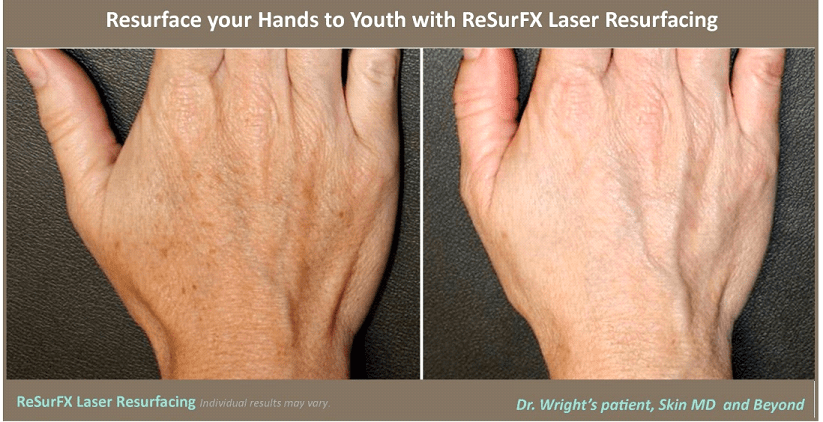 ResurFX Laser Resurfacing