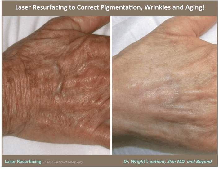 Hand Rejuvenation WRINKLES and CRINKLES Cosmetic Skin Care