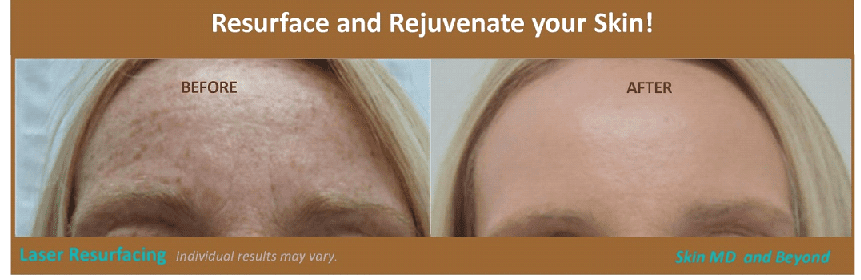 ResurFX Laser Resurfacing