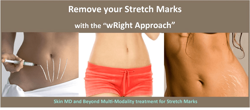 Scars and Stretch Marks