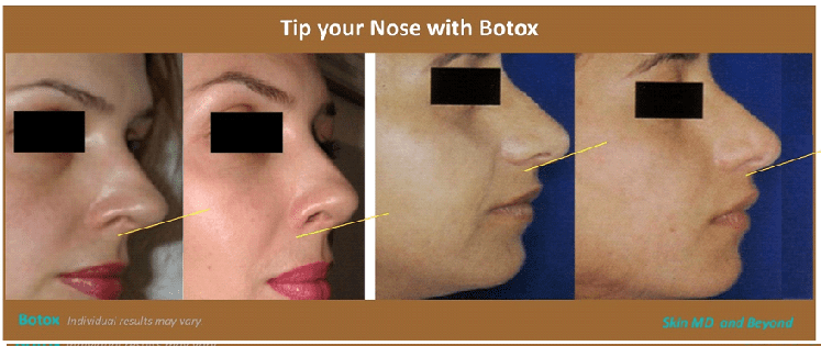 Botox Plano TX | Botox Injection Frisco TX | Botox Treatment