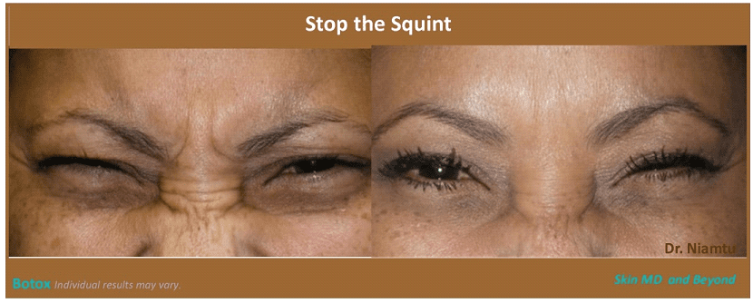 Squint and Nasal Lines