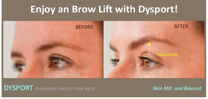 The Mini EYEBROW LIFT