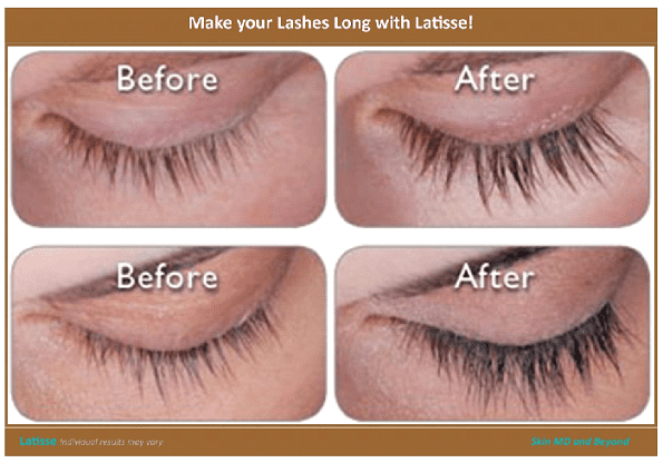 Lash Growth Products, Latisse for Eyelashes