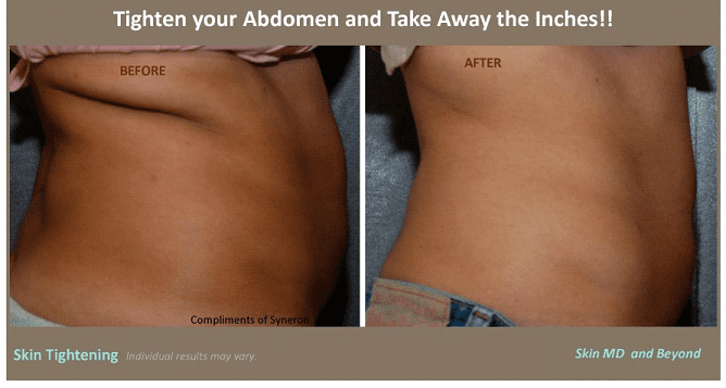 Stomach Skin Tightening Treatments: A Guide