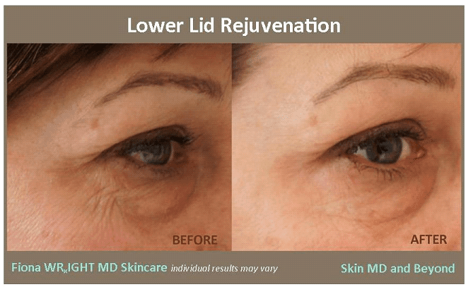 WRINKLES and SUN DAMAGED SKIN