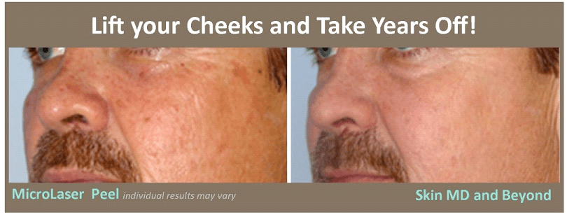 WRINKLES and SUN DAMAGED SKIN