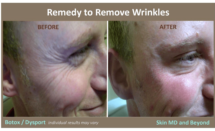 WRINKLES and SUN DAMAGED SKIN