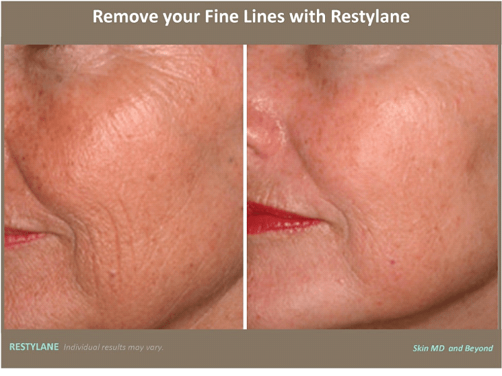 Wrinkles Sun Damaged Skin Cosmetic Skin Care Specialist Plano TX