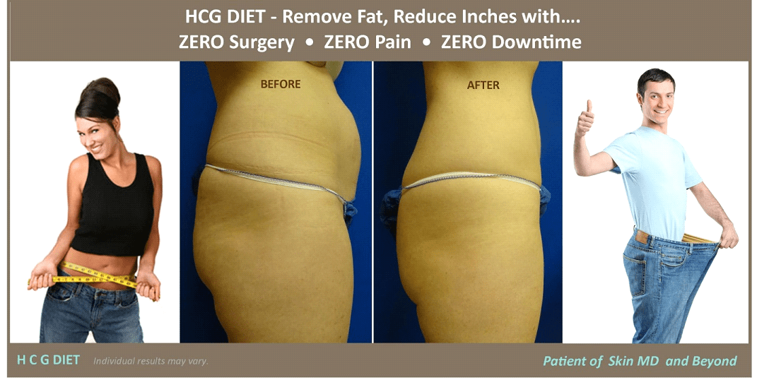 Weight Management - HCG DIET