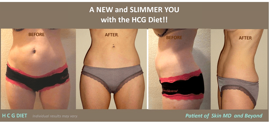 Weight Management - HCG DIET