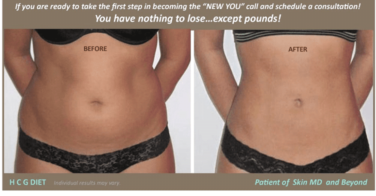 Weight Management - HCG DIET