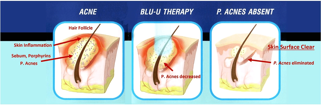 Blue Light And Its Adverse Effects