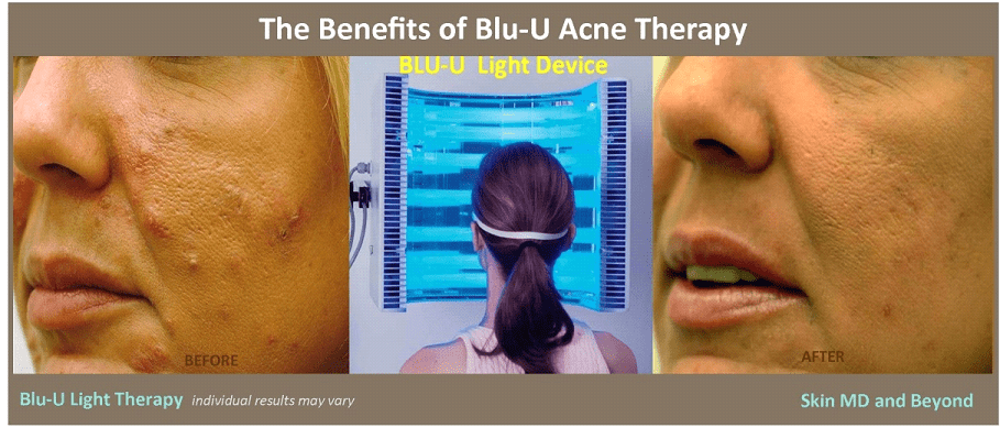 blu u treatment