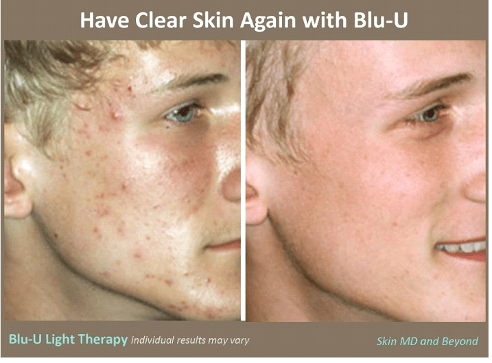 blu u treatment