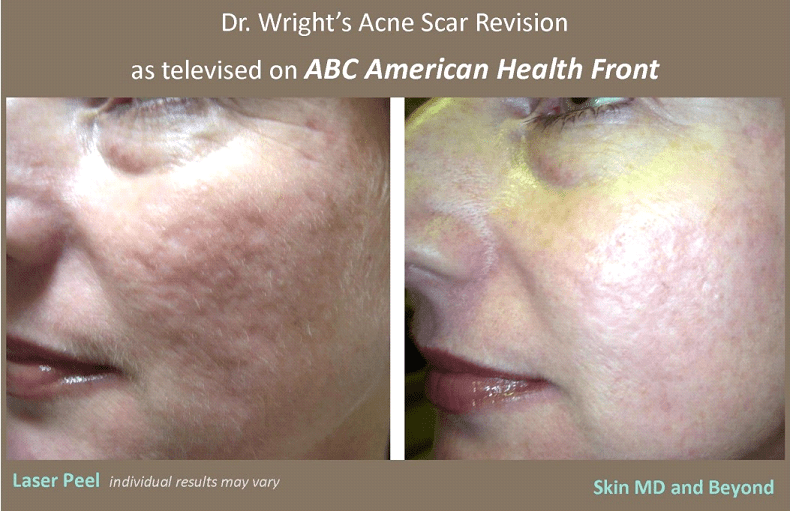 micro laser treatment acne scars