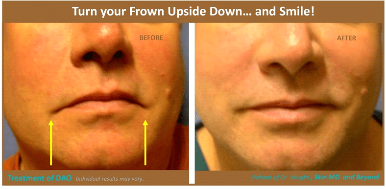 What Causes A Drooping Lower Lip