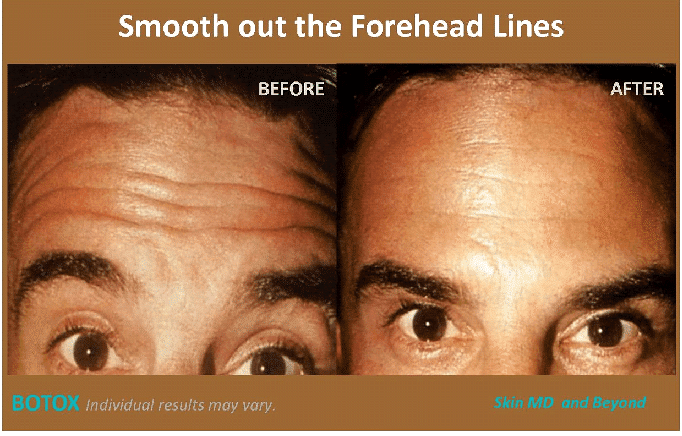 How to Get Rid of Forehead Wrinkles: 10 Fine Line Treatments 2023